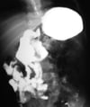 Malrotation intestinale
