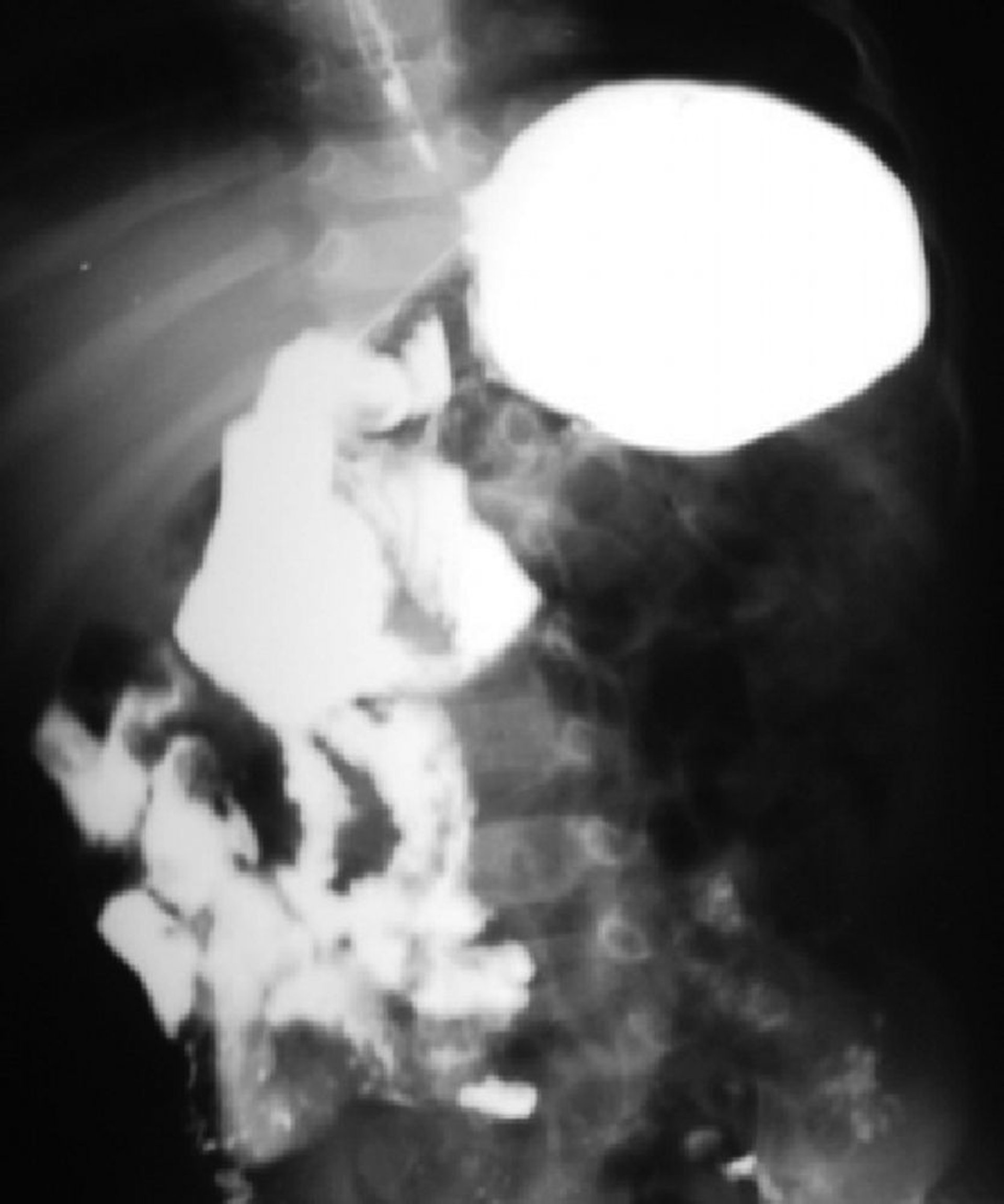 Malrotation intestinale