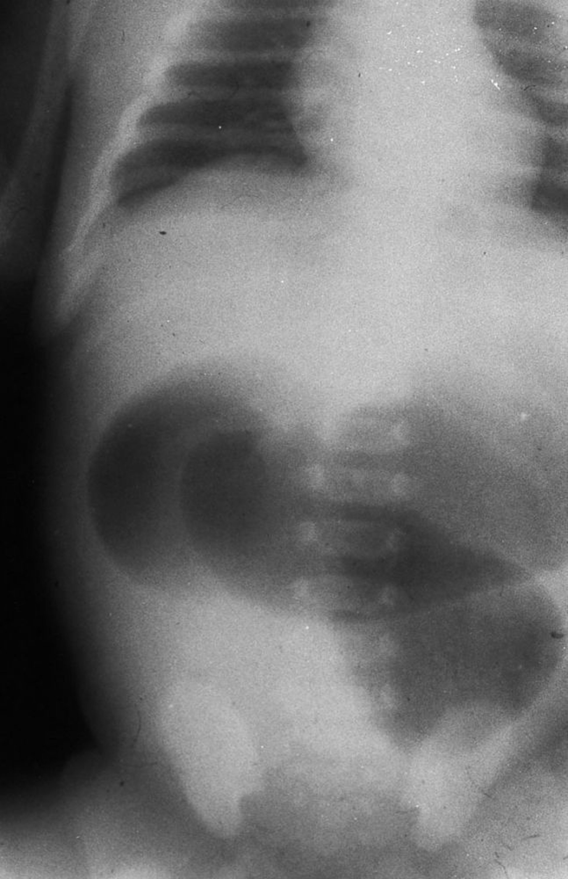 Atresia yeyunal