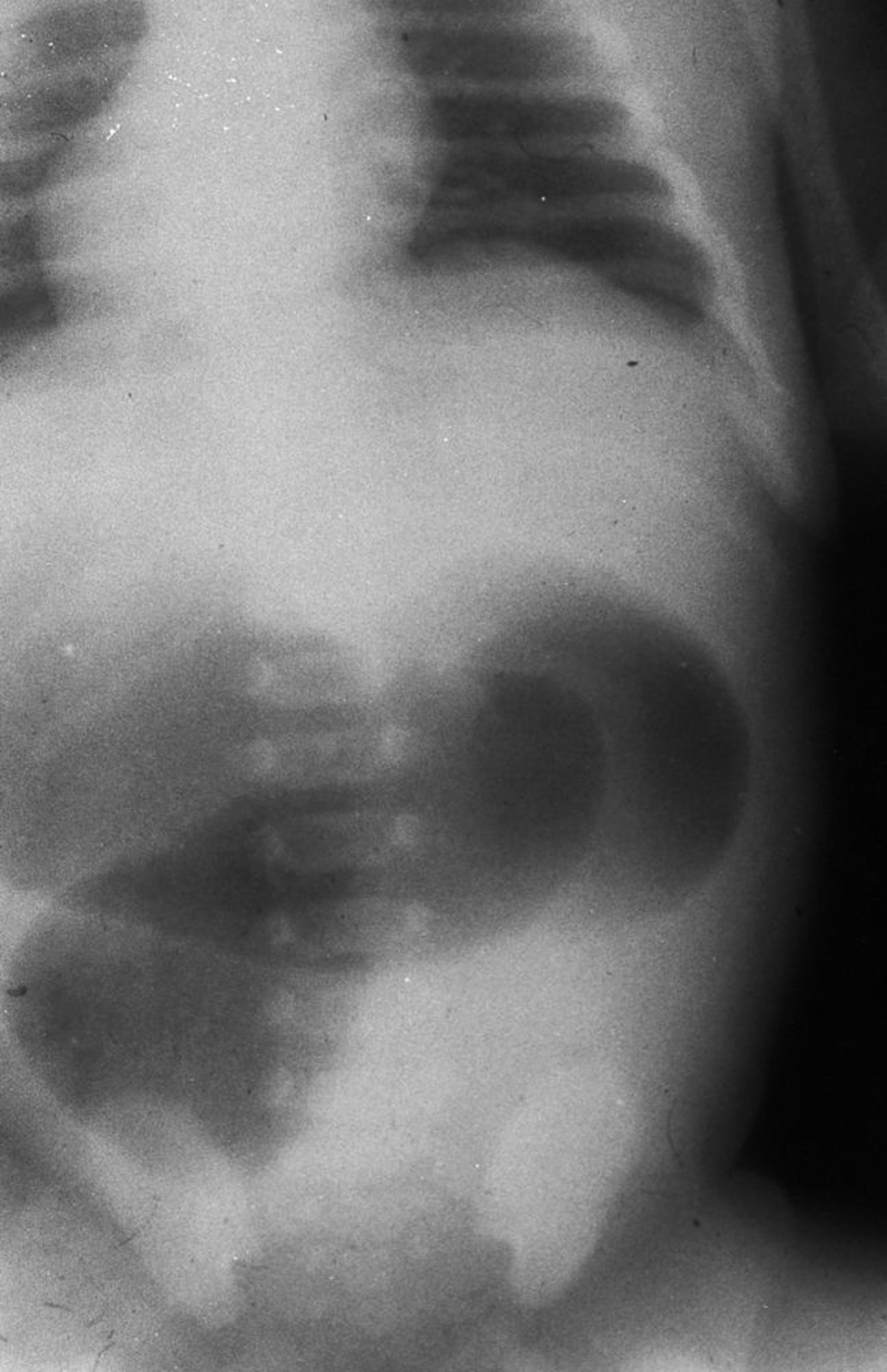 Atresia digiunale