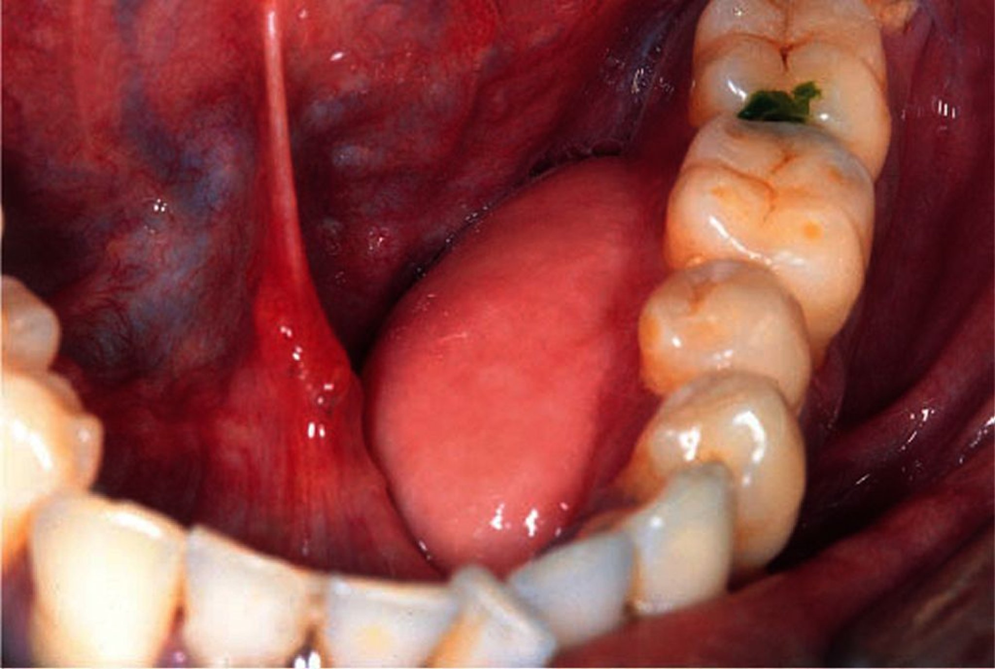 Toro mandibular