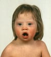 Syndrome de Down (traits du visage)