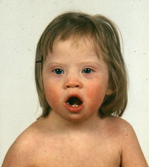Синдромом Дауна (черты лица)