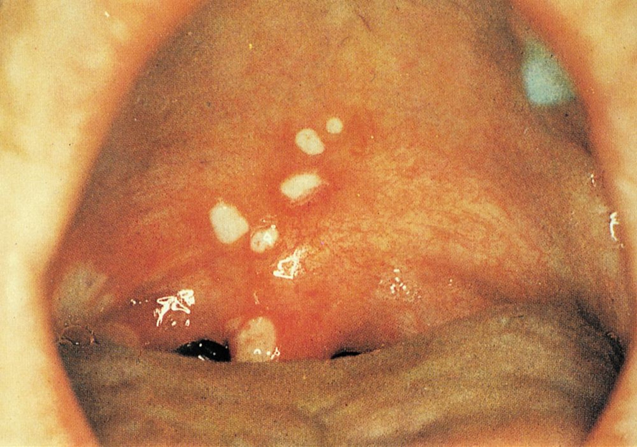 Viêm họng mụn nước