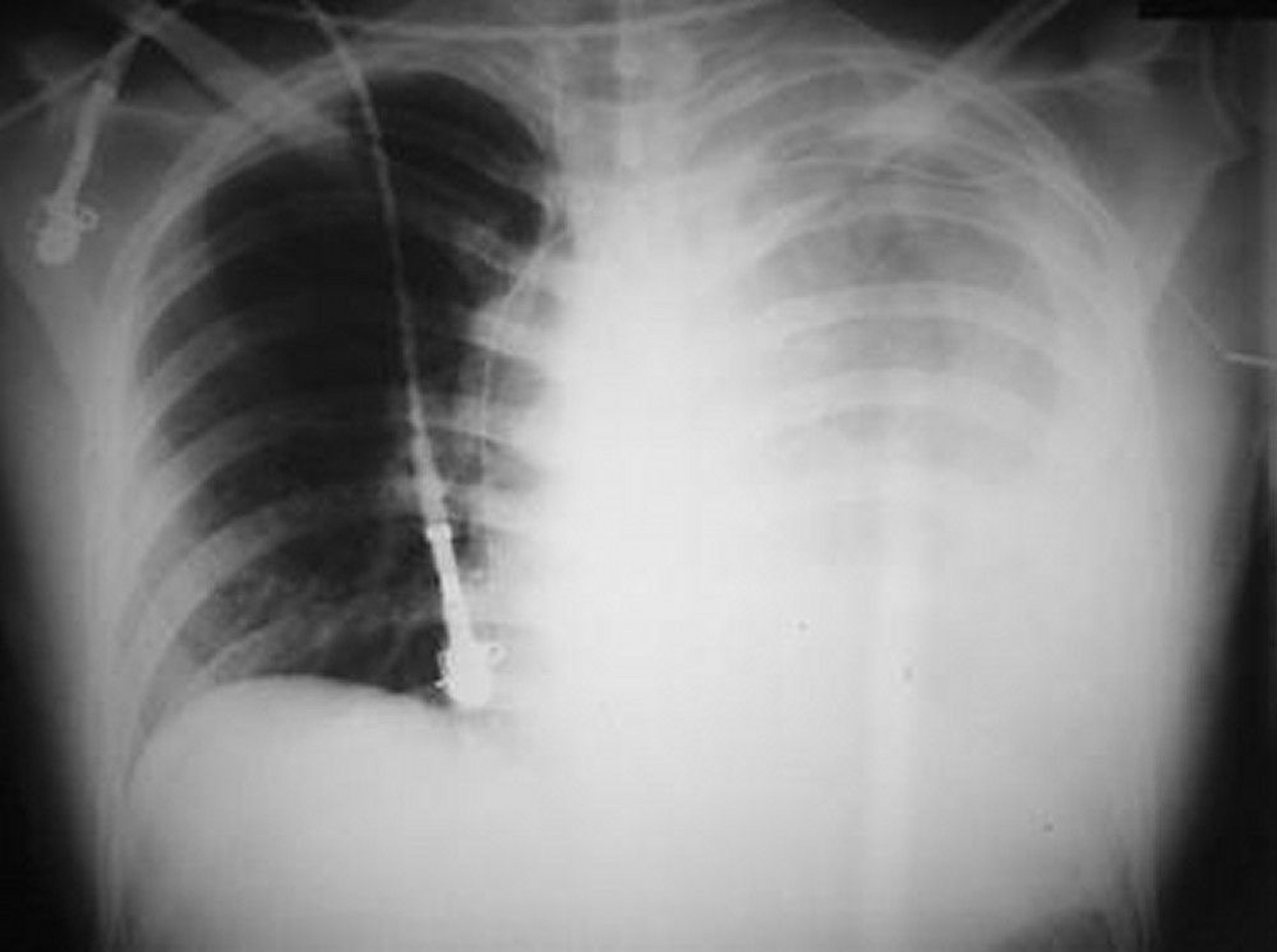 Hemothorax