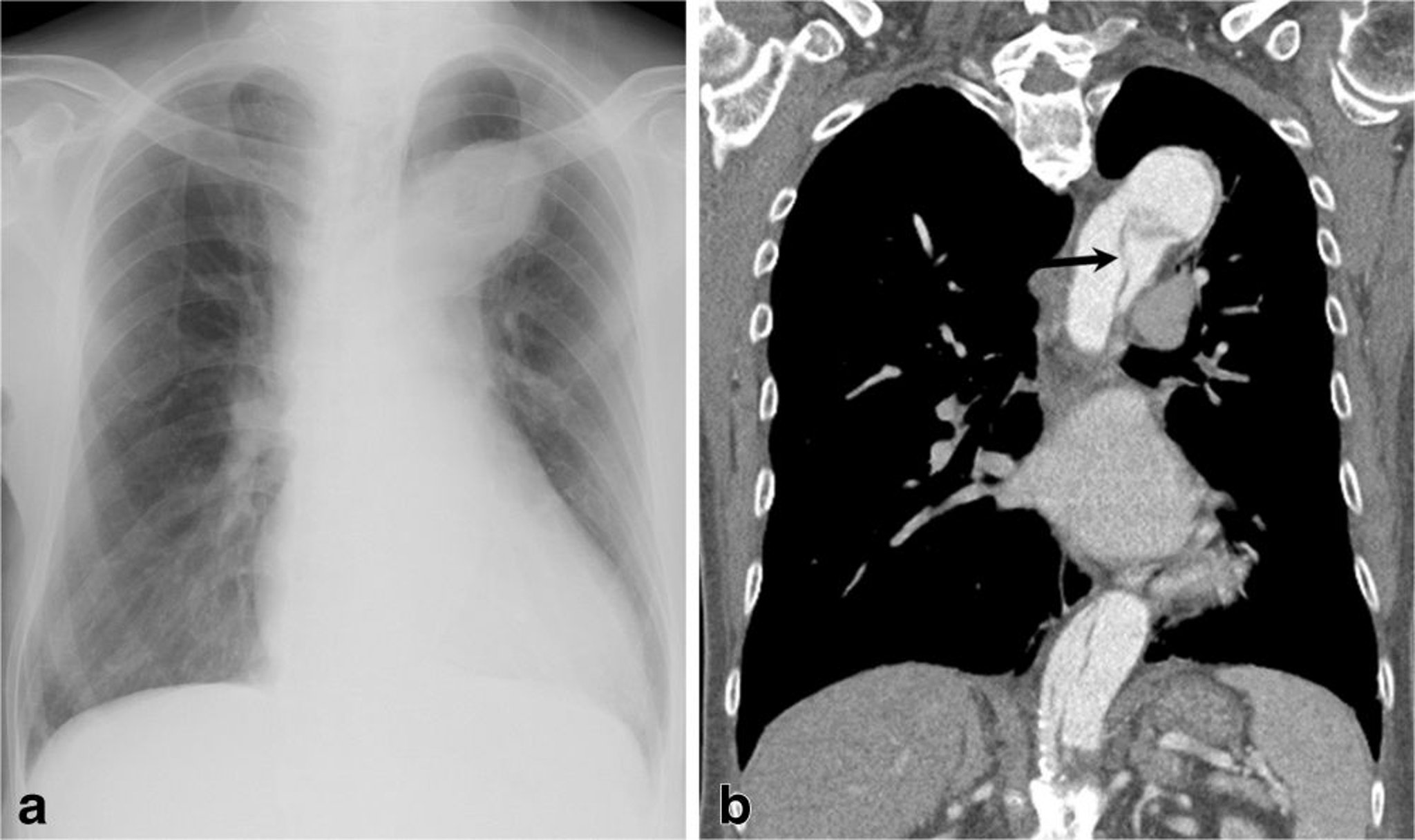 Dissecção da aorta