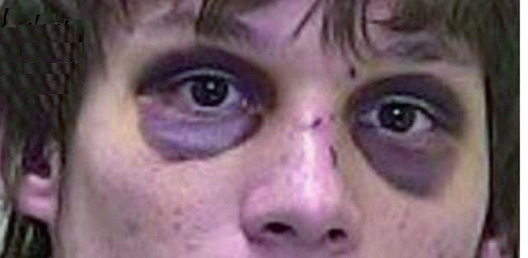 Findings in Basilar Skull Fracture (Periorbital Ecchymosis)