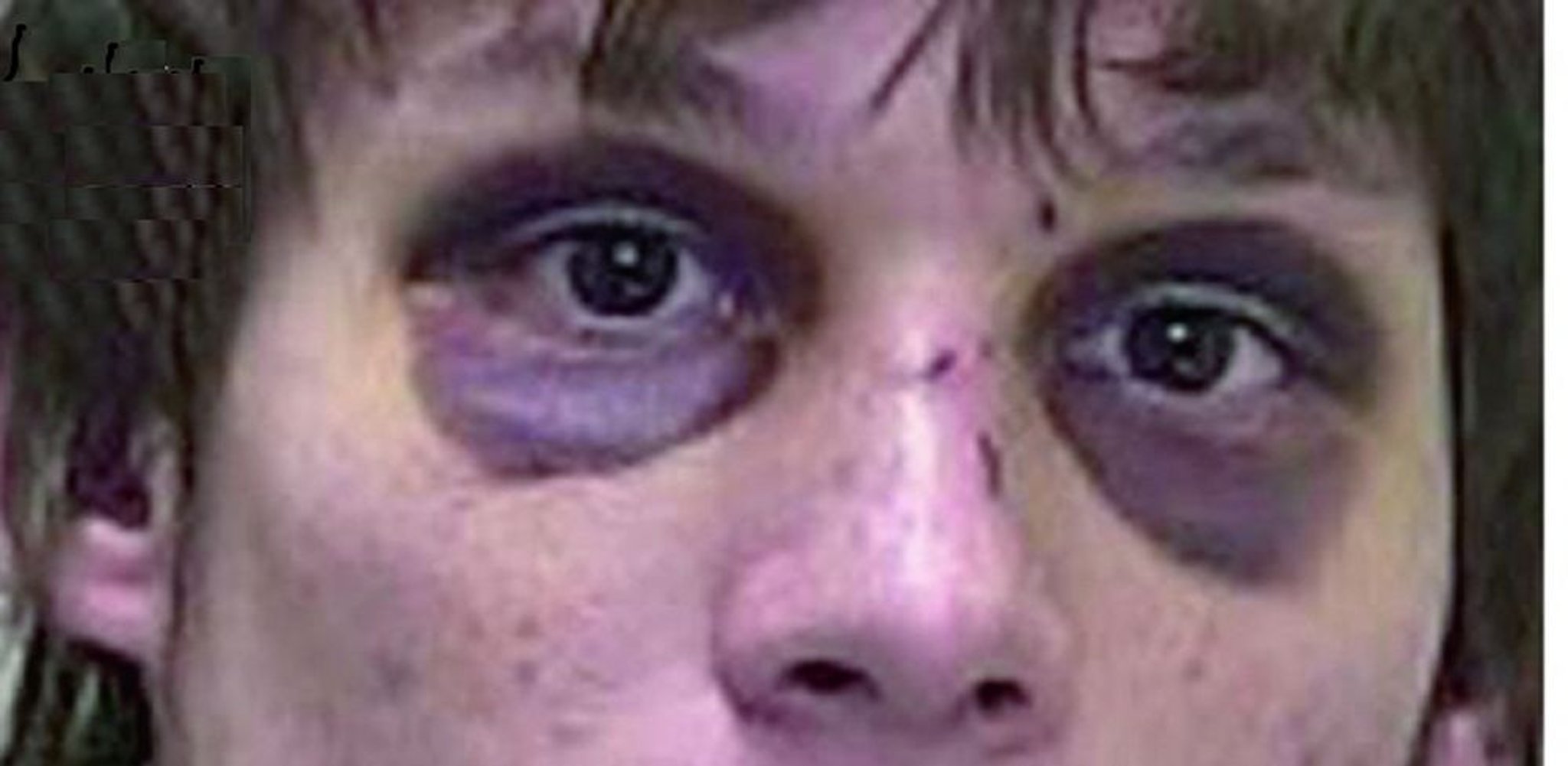 Ознаки перелому основи черепа (екхімоз навколо очей)