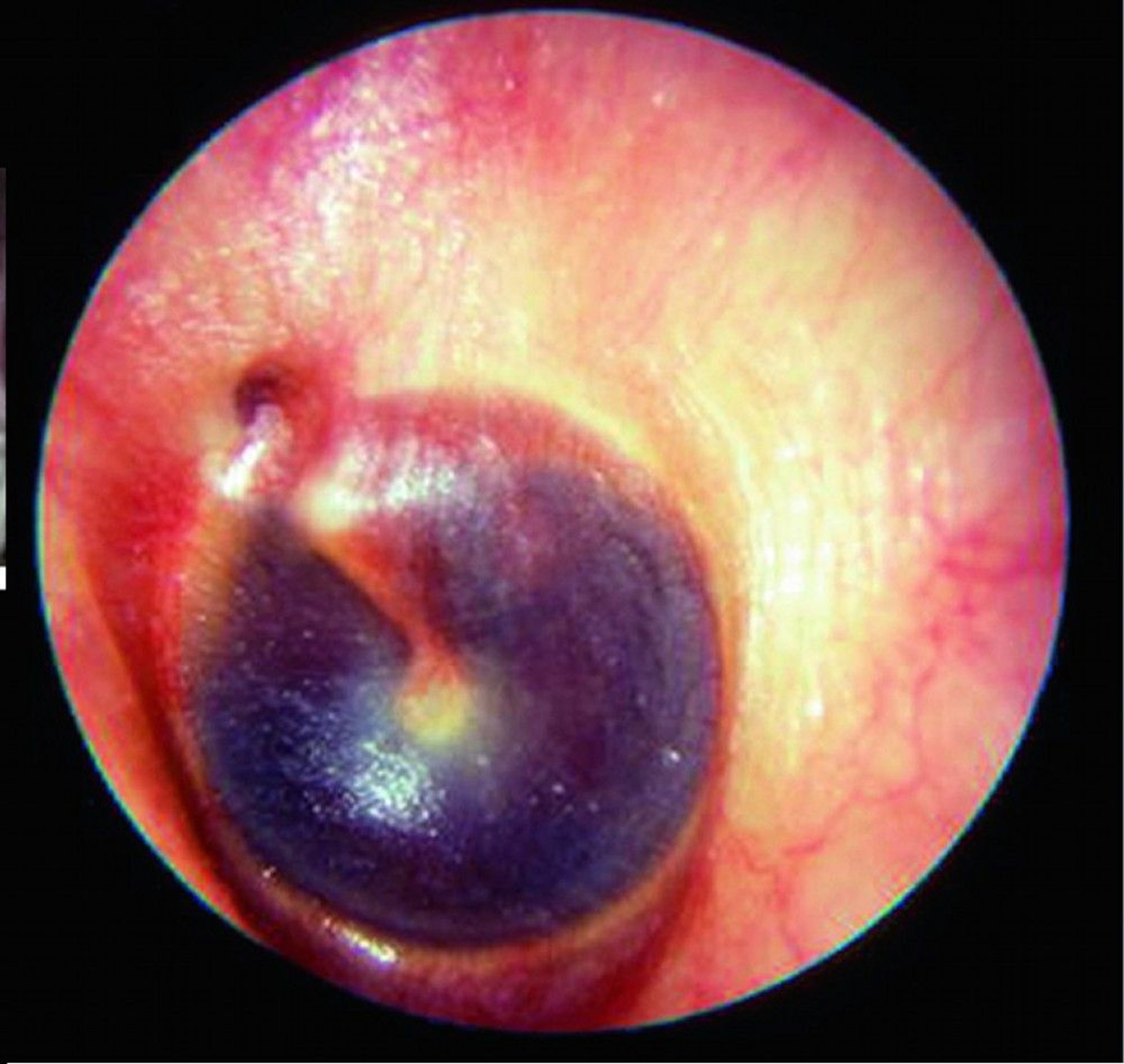 Findings in Basilar Skull Fracture (Hemotympanum)