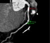 TC con contraste que muestra una arteriopatía coronaria