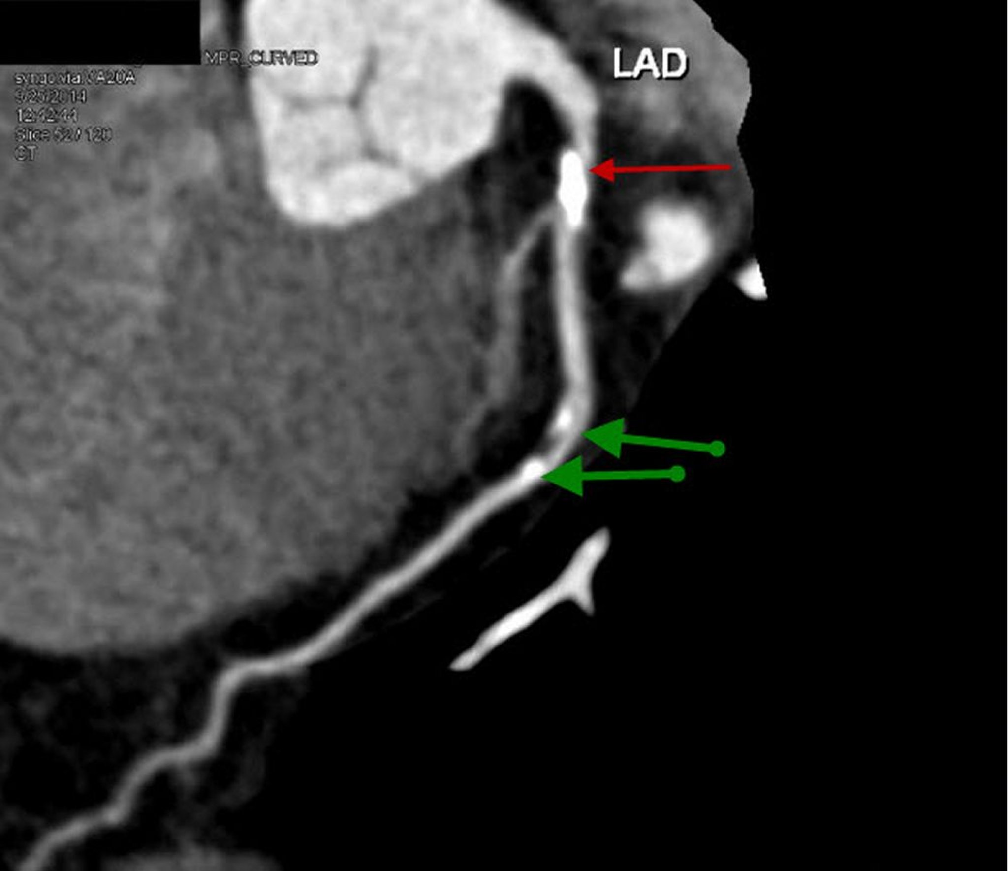 TC con contraste que muestra una arteriopatía coronaria