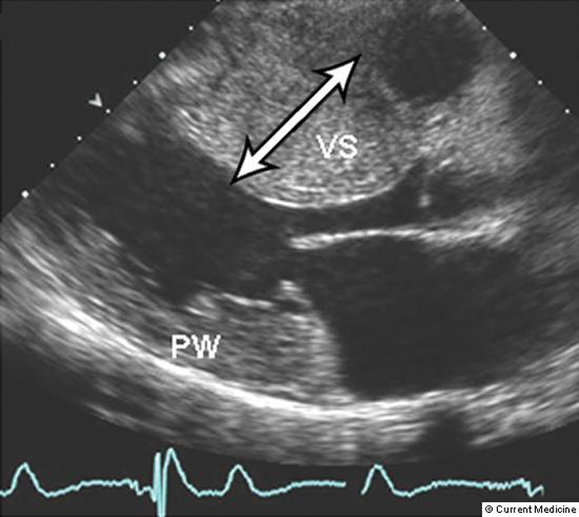 Septal Thickening in Hypertrophic Cardiomyopathy