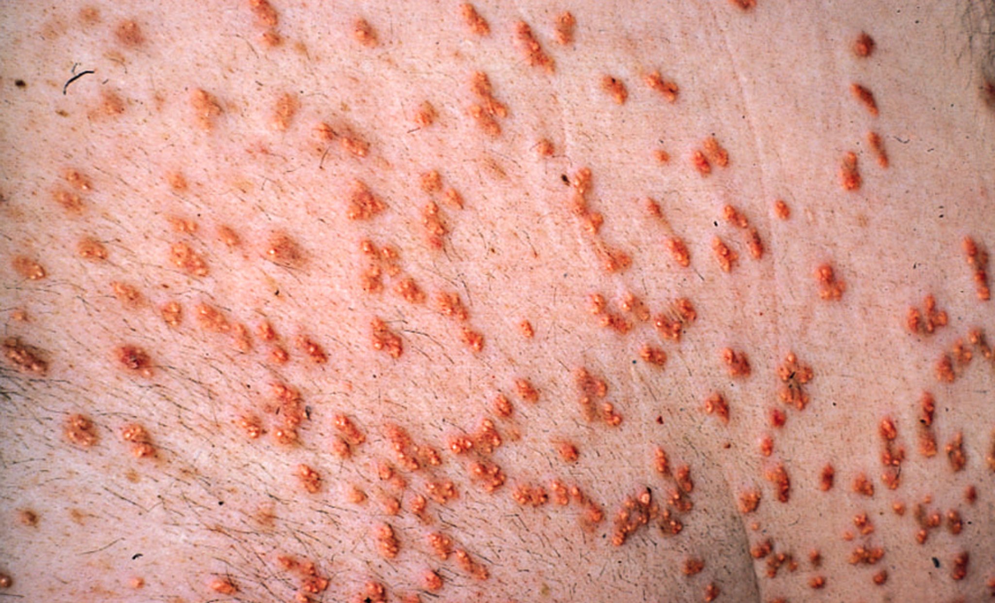 Eruptive Xanthoma