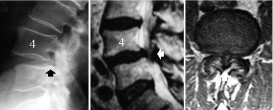 Lumbar Spinal Stenosis Caused by Degenerative Spondylolisthesis of L4-L5