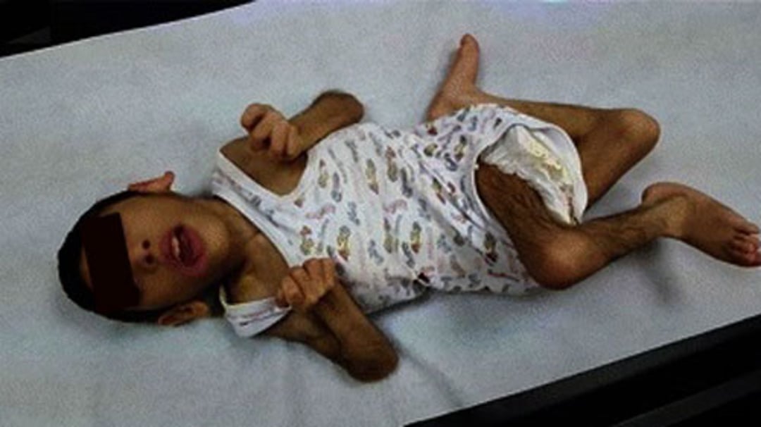Microcephaly
