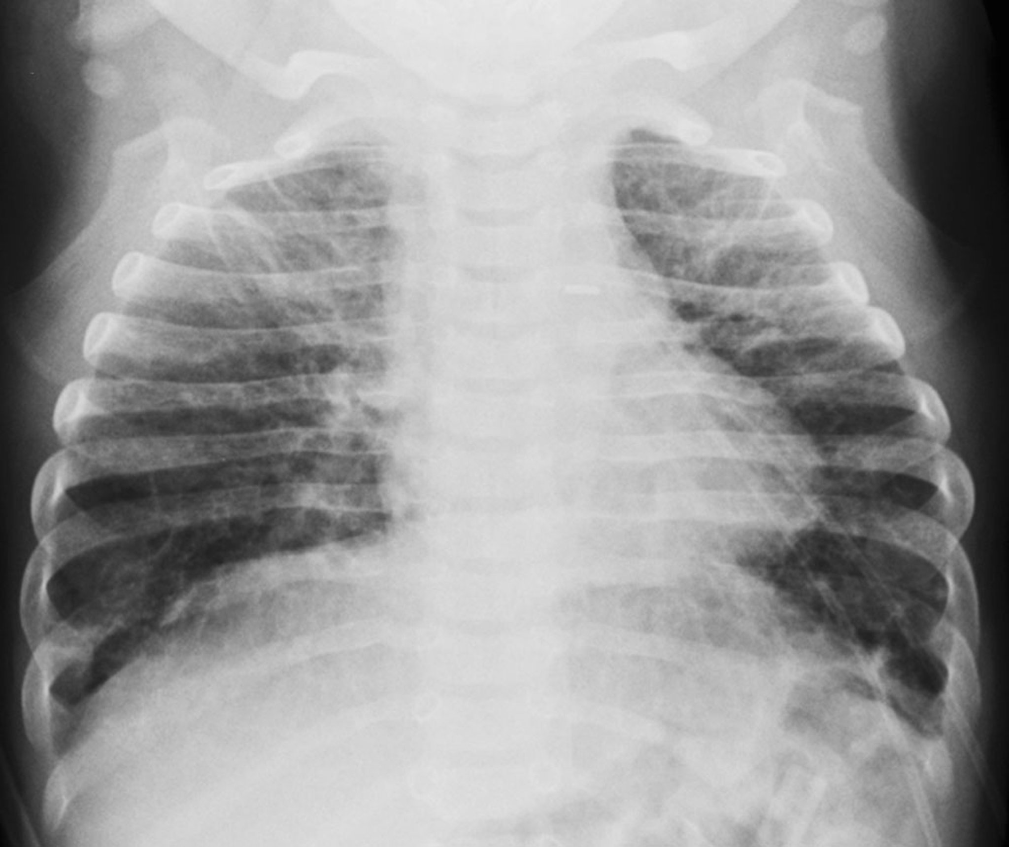 Bronchopulmonary Dysplasia (Radiograph)