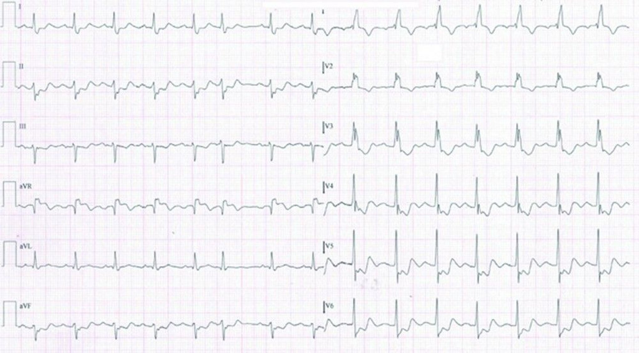 case study 1 acute myocardial infarction answers