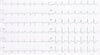 Infarto de miocardio sin supradesnivel del segmento ST