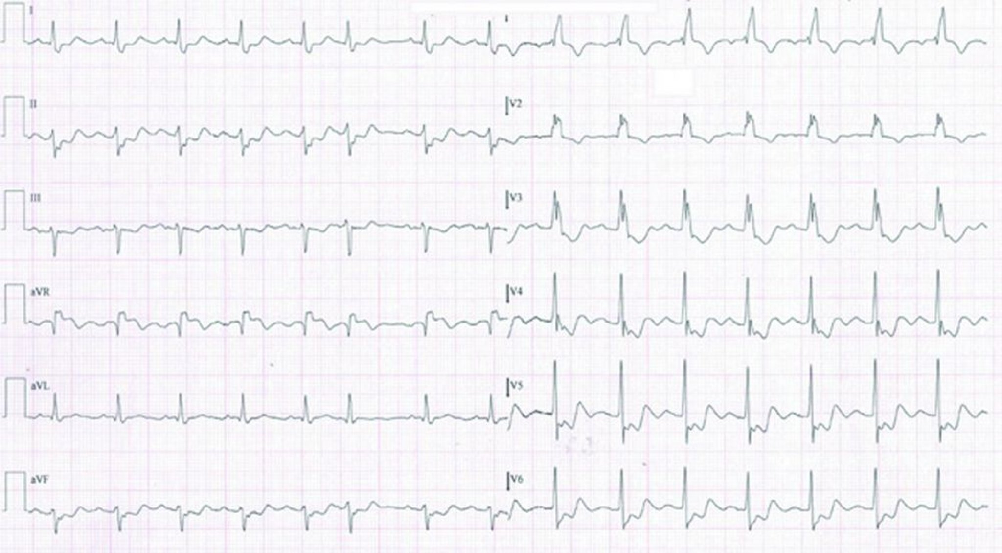 Infarto de miocardio sin supradesnivel del segmento ST