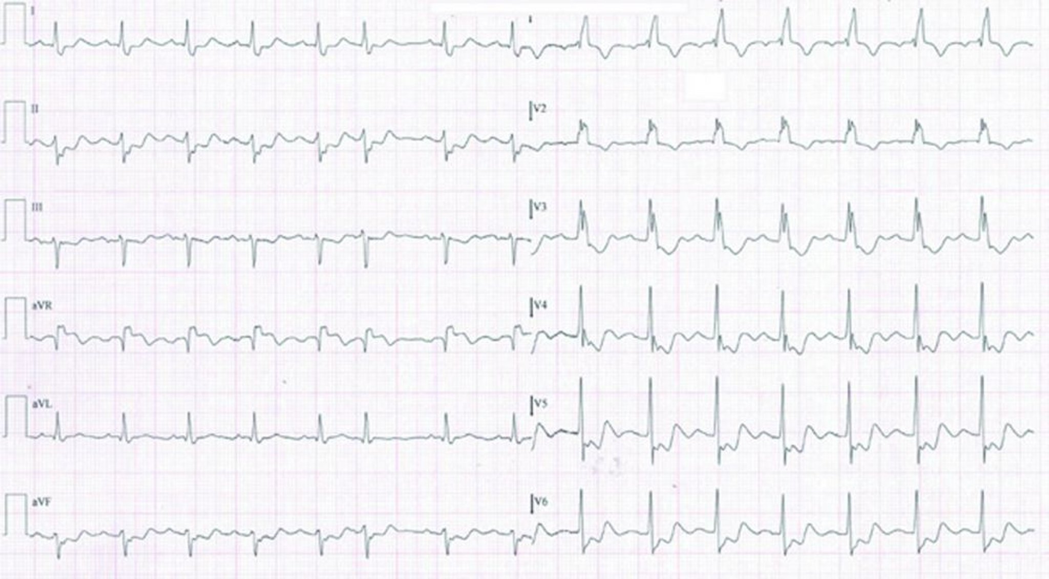 NSTEMI