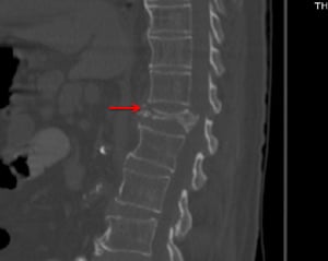 Grave frattura vertebrale da compressione (TC)