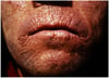Erythropoietic Protoporphyria (Carp Mouth)
