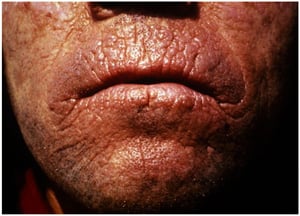 红细胞生成性原卟啉症（Carp Mouth）