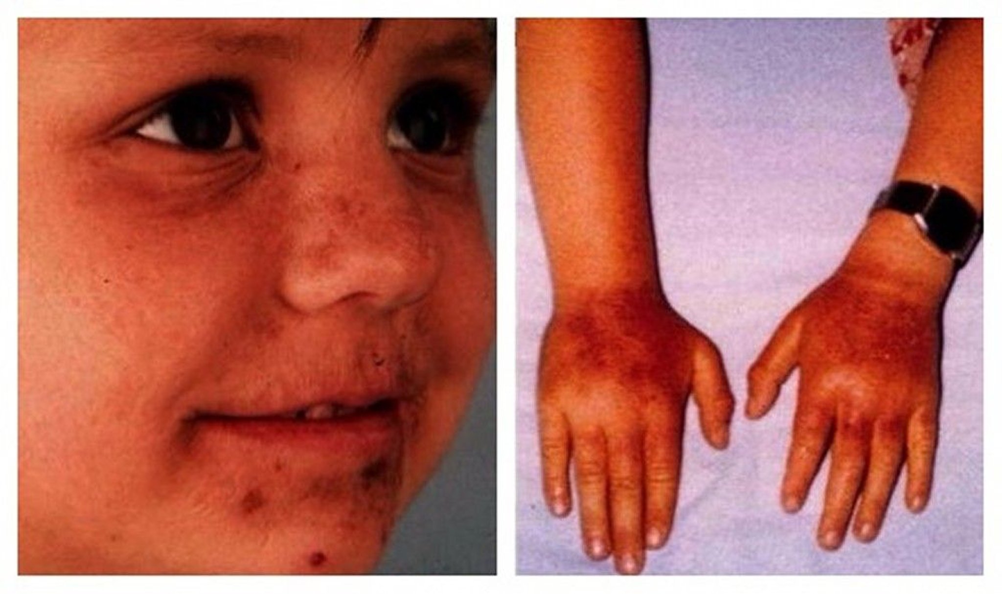 Erythropoietic Protoporphyria (Acute Photosensitivity)