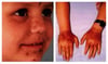 Erythropoietic Protoporphyria (Acute Photosensitivity)