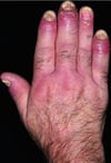Psoriasis (dactilitis)