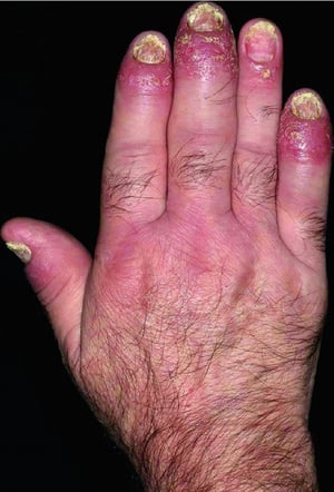 Psoriasis (dactilitis)