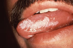 Волосистая лейкоплакия полости рта