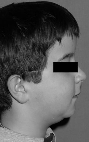 Пикнодизостоз (микрогнатия нижней челюсти)