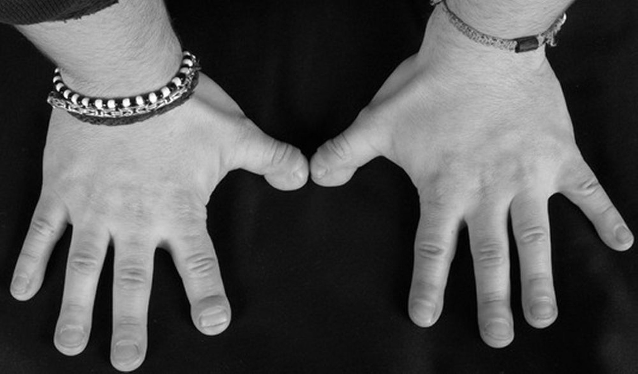 Picnodisostosis (manos)