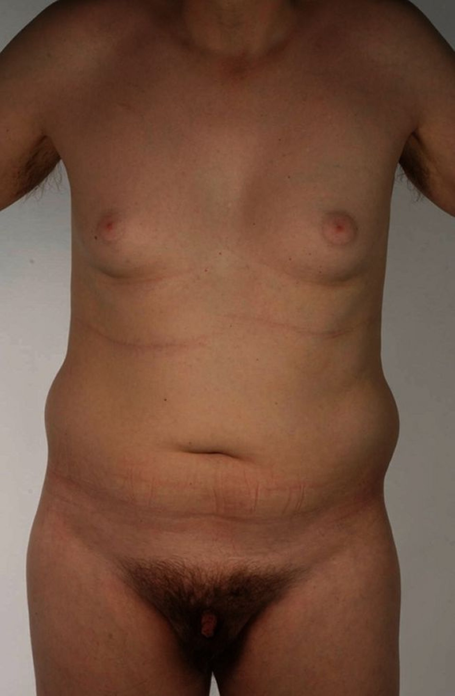 Klinefelter Syndrome