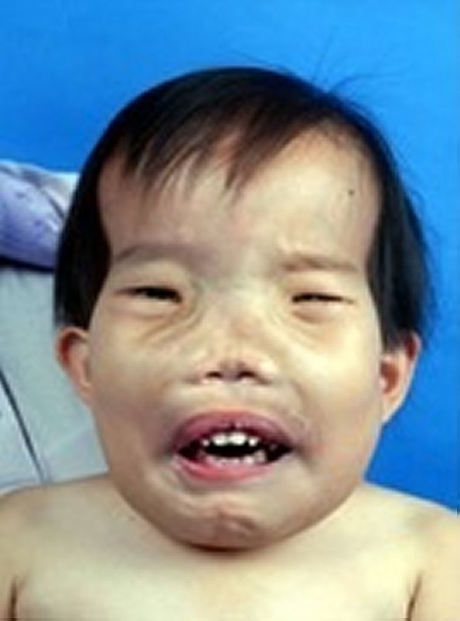 硬皮病（头面部特征）