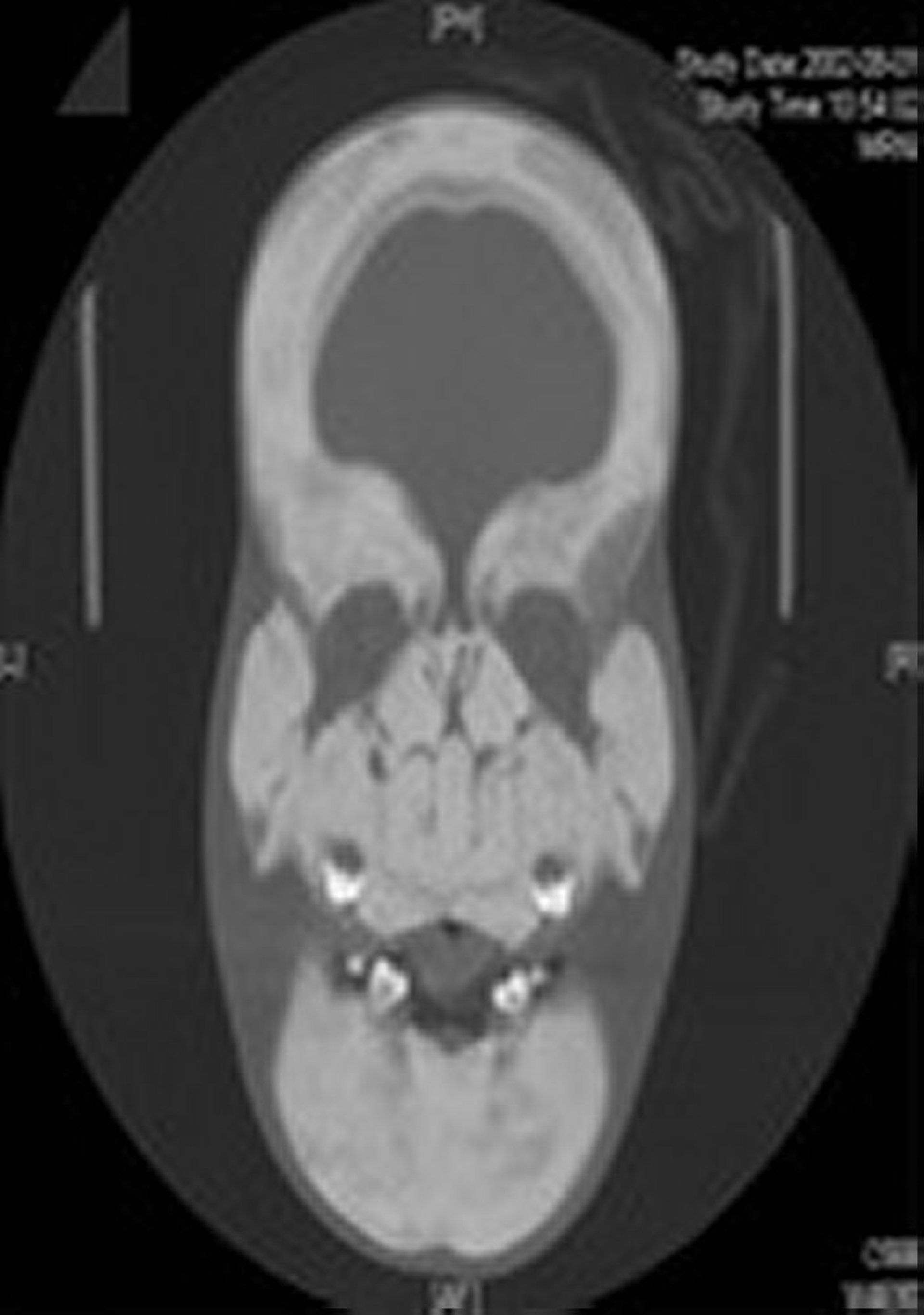 Sclérostéose (radiographie)