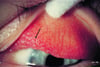 Conjuntivitis vernal