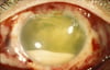 Endoftalmitis