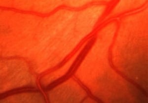 Гипертоническая ретинопатия (симптом "медной проволоки")