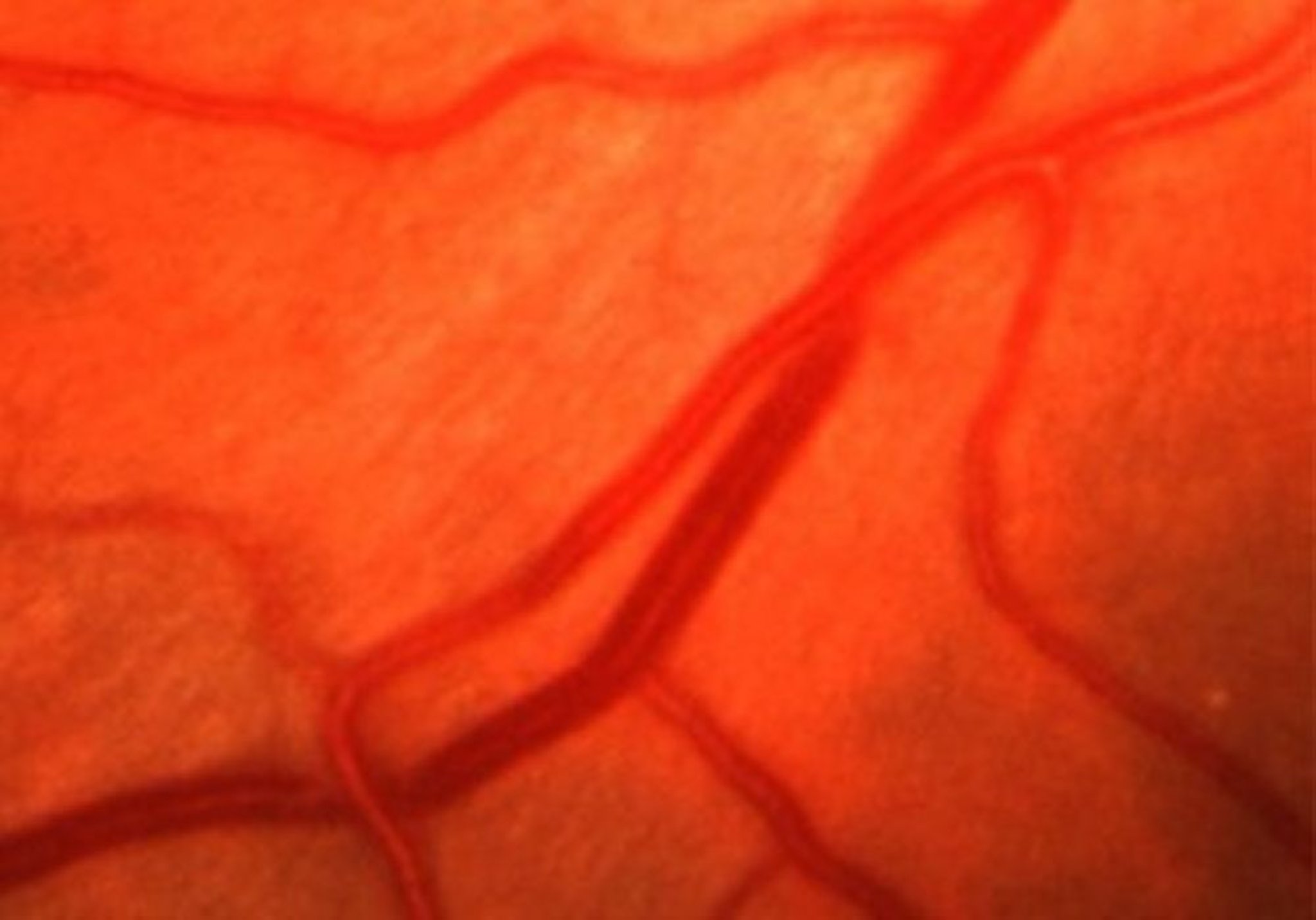 Hypertensive Retinopathy (Copper Wiring)