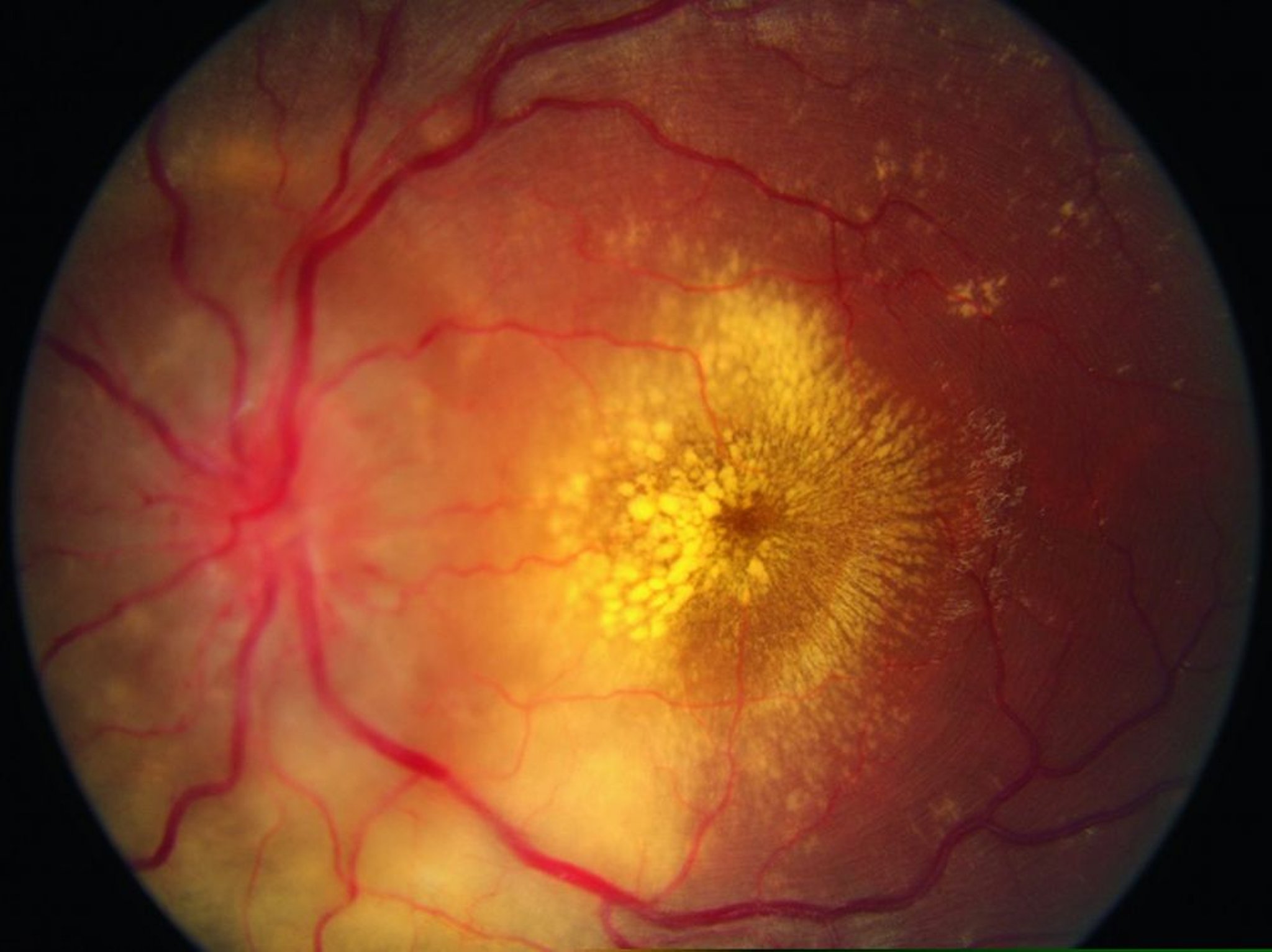 Hypertensive Retinopathie (sternförmige Exsudate und Papillenödem)