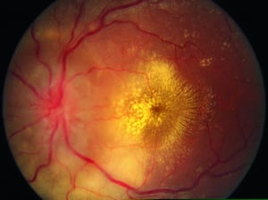 Retinopatia ipertensiva (essudati a forma di stella e papilledema)