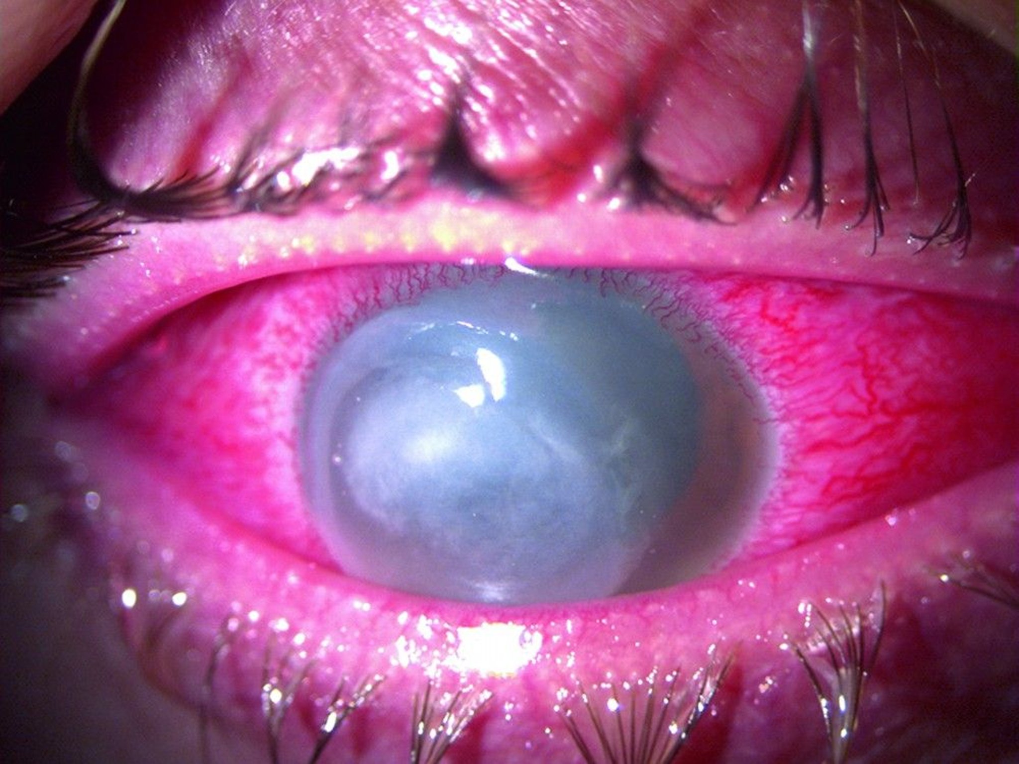 Keratitis (Interstitial)