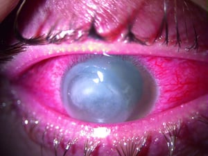 Keratitis (interstitielle)