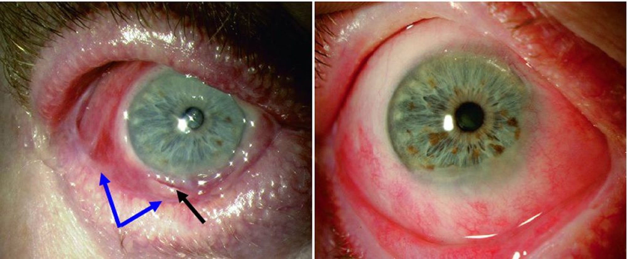 Penfigoide de la membrana mucosa ocular