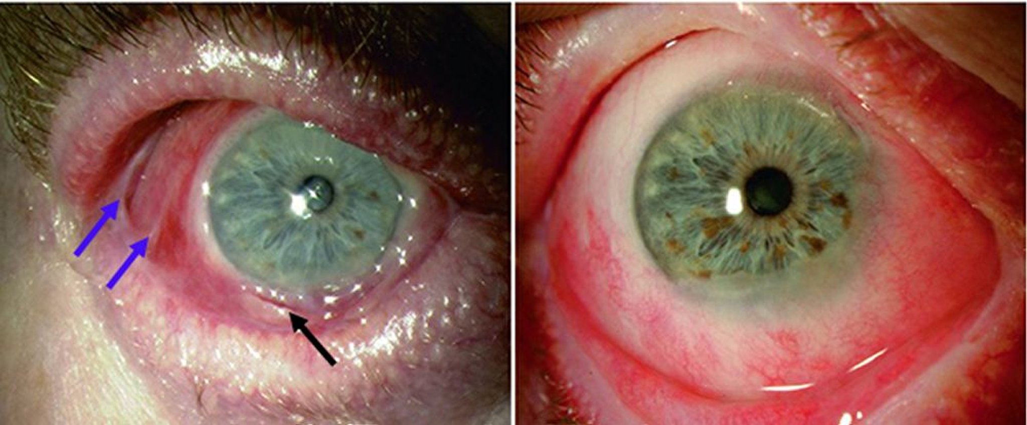 Pemphigoïde des muqueuses oculaires