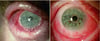 Pemfigoide delle mucose oculari