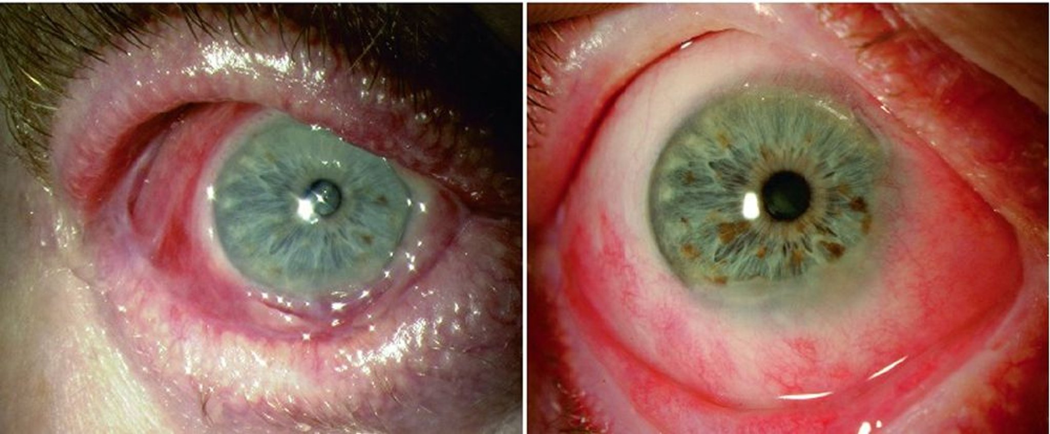 Pemfigoide delle mucose oculari