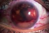 Sarcoidosis (granuloma del iris)